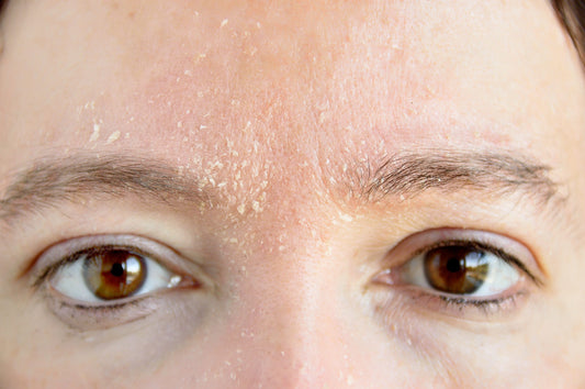 woman's face with dry skin on face around eyebrows